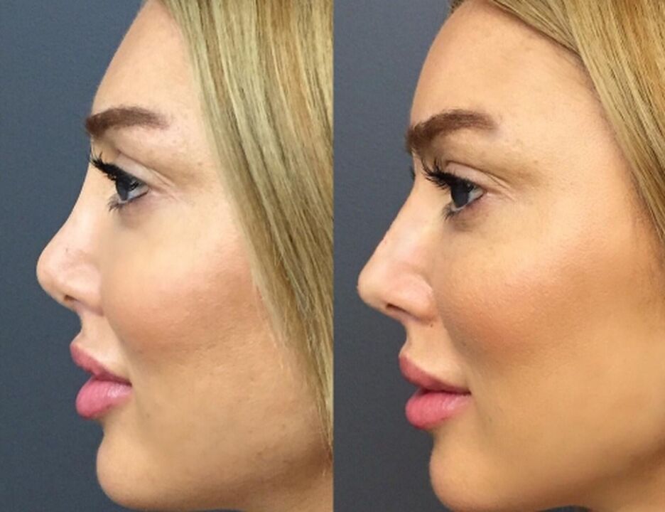 Nose plastic