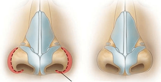 Reduction of nasal passages