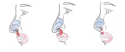 Truncation of part of the nasal muscle.