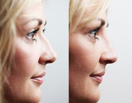 Before and after rhinoplasty with fillers