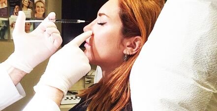 Rhinoplasty procedure with fillers.