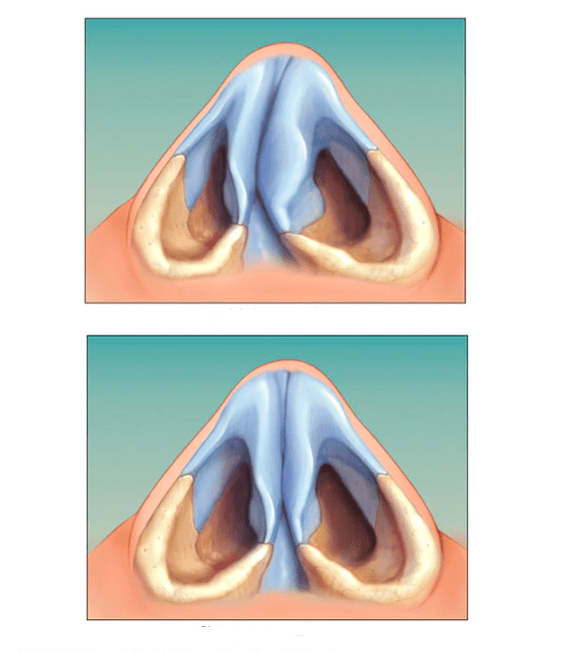 corrected nasal septum