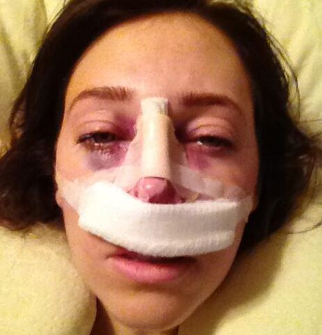 After surgery, a plaster bandage is applied to the nose.