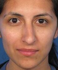 The irregular shape of the nose is a reason for plastic surgery.