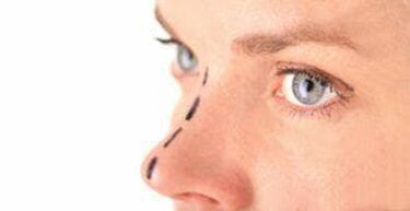Marking on the nose for insertion of cosmetic threads.