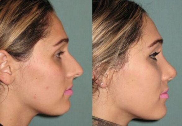 the result of a rhinoplasty without injection