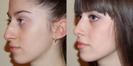photos before and after nose rhinoplasty