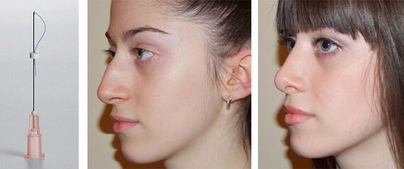 before and after rhinoplasty with mesothreads