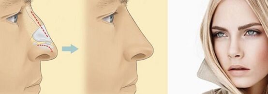nose shape correction with non-surgical rhinoplasty