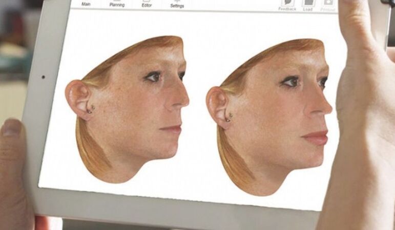 Computer modeling method of the nose before rhinoplasty. 