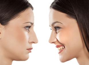 The rhinoplasty of the nose before and after