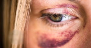 Bruises on the face