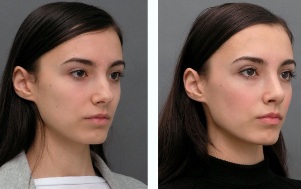 The girl of before and after rhinoplasty of nose