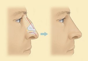 As it passes the brush of rhinoplasty