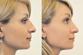 Non-surgical rhinoplasty photo before and after